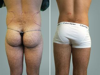 Lipo Laser System prima e dopo