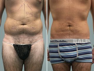 Lipo Laser System prima e dopo