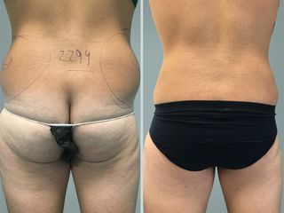 Lipo Laser System prima e dopo