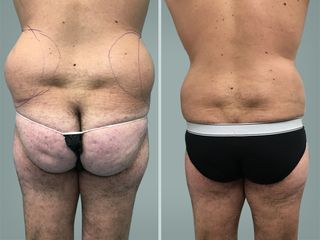 Lipo Laser System prima e dopo