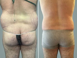 Lipo Laser System prima e dopo