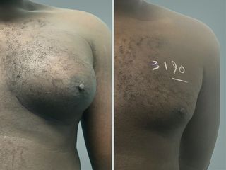 Lipo Laser System prima e dopo