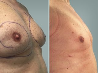 Lipo Laser System prima e dopo