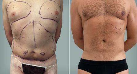 Lipo Laser System prima e dopo