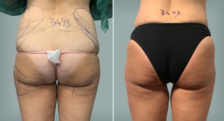 Lipo Laser System prima e dopo