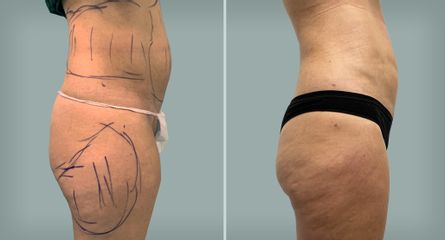 Lipo Laser System prima e dopo