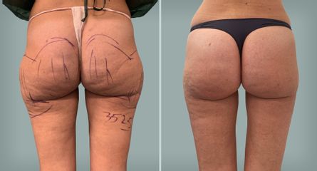 Lipo Laser System prima e dopo