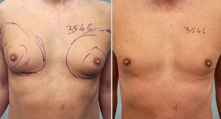 Lipo Laser System prima e dopo