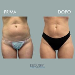 Liposuzione - Equipe Estetica