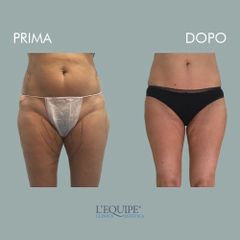 Liposuzione - Equipe Estetica