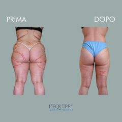 Liposuzione - Equipe Estetica