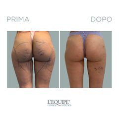 Laserlipolisi - Equipe Estetica