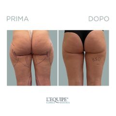 Laserlipolisi - Equipe Estetica
