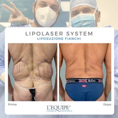 Liposuzione - Equipe Estetica