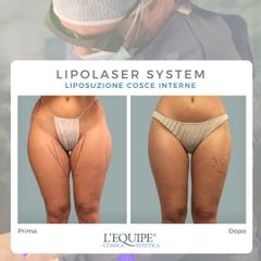 Liposuzione - Equipe Estetica