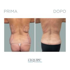 Liposuzione - Equipe Estetica