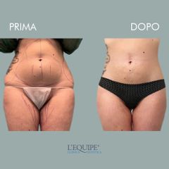 Liposuzione - Equipe Estetica
