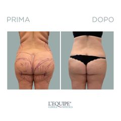 Liposuzione - Equipe Estetica