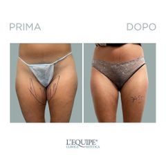 Liposuzione - Equipe Estetica