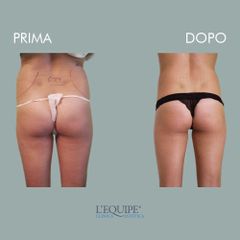 Liposuzione - Equipe Estetica