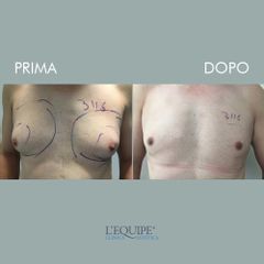 Liposuzione - Equipe Estetica