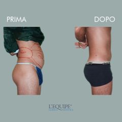 Liposuzione - Equipe Estetica