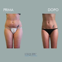 Liposuzione - Equipe Estetica