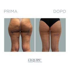 Liposuzione - Equipe Estetica