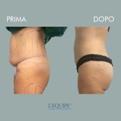 Liposuzione - Equipe Estetica