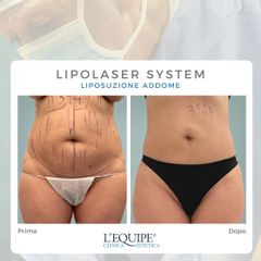 Liposuzione - Equipe Estetica