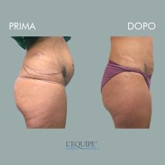Liposuzione - Equipe Estetica