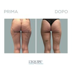 Liposuzione - Equipe Estetica