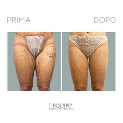 Liposuzione - Equipe Estetica