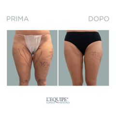 Liposuzione - Equipe Estetica