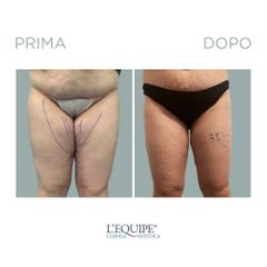 Liposuzione - Equipe Estetica