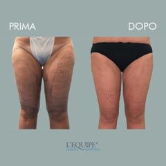 Liposuzione - Equipe Estetica