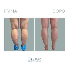 Liposuzione - Equipe Estetica