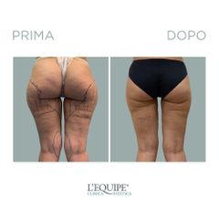 Liposuzione - Equipe Estetica