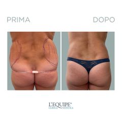 Liposuzione - Equipe Estetica