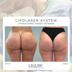 Liposuzione - Equipe Estetica