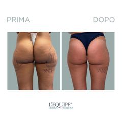Liposuzione - Equipe Estetica
