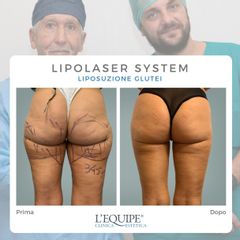 Liposuzione - Equipe Estetica