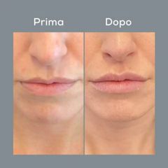 Filler labbra  - Centro Laser Dermatologico Dott. Laspina