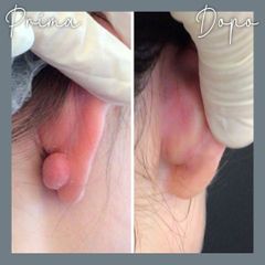 Verruche - Centro Laser Dermatologico Dott. Laspina