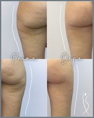 Cellulite - Centro Laser Dermatologico Dott. Laspina
