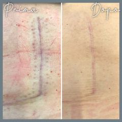 Cicatrici - Centro Laser Dermatologico Dott. Laspina