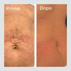 Smagliature - Centro Laser Dermatologico Dott. Laspina
