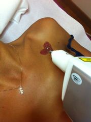 Rimozione tatuaggi colorati