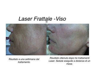 Laser Frattale prima e dopo