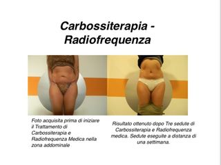 Carbossiterapia e Radiofrequenza prima e dopo